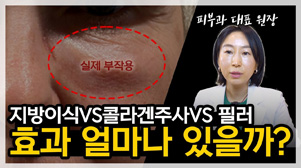 지방이식VS콜라겐주사VS필러 , 내얼굴 볼륨에 가장 효과적인 방법은?